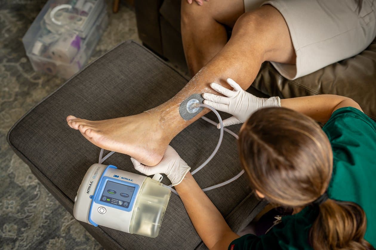 Negative Pressure Wound Therapy (NPWT)